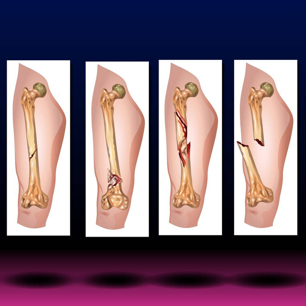 Thigh Bones - Fla διαθέσιμο αρχείο πηγαίου κώδικα - Το μηριαίο οστό είναι το μακρύτερο, δυνατότερο οστό στο σώμα σας. Παίζει σημαντικό ρόλο στον τρόπο που στέκεσαι, κινείσαι και κρατάς την ισορροπία σου. Τα πόδια συνήθως σπάνε από σοβαρά τραύματα όπως τα τροχαία ατυχήματα.. - Φωτογραφία, εικόνα