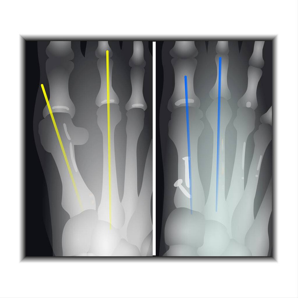 X-ray του Foot Claw - Fla πηγή αρχείο διαθέσιμο - Φωτογραφία, εικόνα