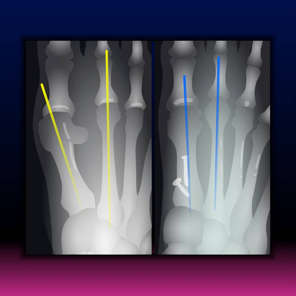 X-ray του Foot Claw - Fla πηγή αρχείο διαθέσιμο - Φωτογραφία, εικόνα