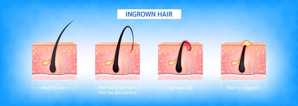 Aikuiset hiukset. Hiukset ovat kasvaneet takaisin ihon pintaan parranajon jälkeen. Muodostaminen ihon akne tai näppylä. Hiusten ja ihon anatomian infografia. 3D-vektorikuvitus. - Vektori, kuva