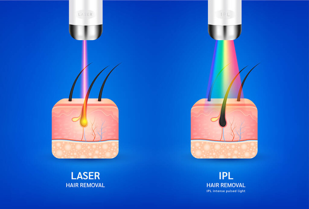 Huidlagen anatomie met haren. Laser en IPL licht (Intense Pulsed Light) ontharing. Ongewenste uittreding maakt de huid glad. Gebruikt voor schoonheidsreclame. Medisch-wetenschappelijk concept. 3D realistische vector. - Vector, afbeelding