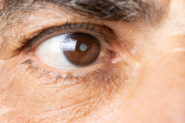 Глаз пожилого человека с катарактой, облачность хрусталика, макро - Фото, изображение