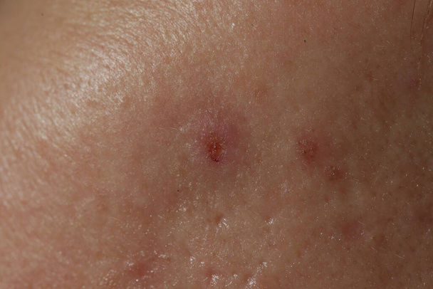 Primer plano extremo de la textura de la piel humana problemática con grandes poros abiertos y cicatrices de acné - Foto, imagen