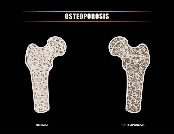 Ilustracja międzystawowego porównania kości udowej i biodrowej z normalnymi objawami osteoporozy. - Wektor, obraz