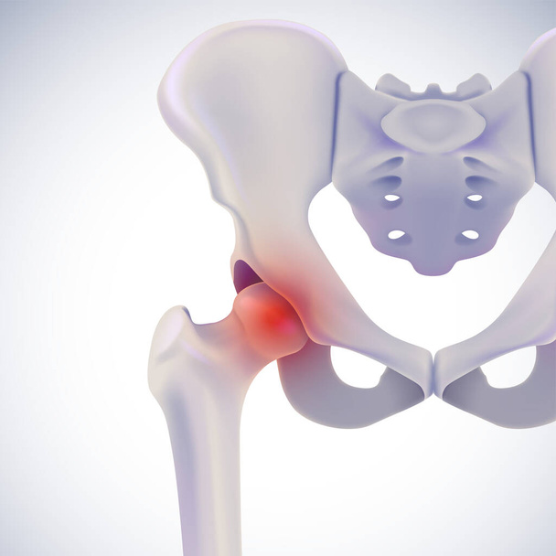 Illustrazione 3D della vista anteriore dell'osso dell'anca che mostra una posizione dolorosa sul bianco. - Vettoriali, immagini