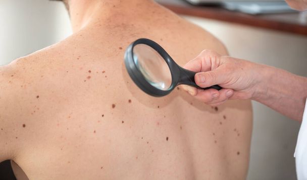 Dermatolog vyšetření kůže pacienta zpět - Fotografie, Obrázek