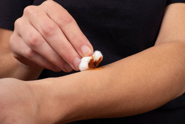 Ätzung einer Wunde am Arm mit Jodlösung und Watte, gesunde Hautpflege - Foto, Bild