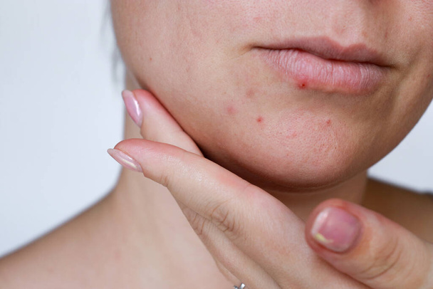 Nahaufnahme natürliche Frau schlechte Akne-Haut mit Narben. Hochwertiges Foto - Foto, Bild