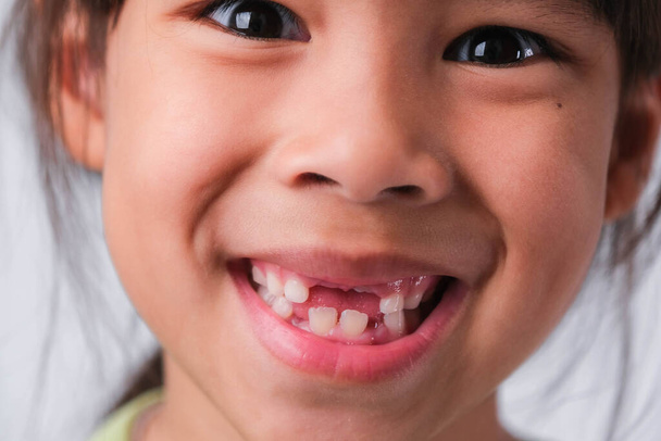 Retrato de uma menina asiática com dentes de bebê superiores quebrados e primeiros dentes permanentes. Amigável menina mostrando seus dentes quebrados isolado no fundo branco. - Foto, Imagem