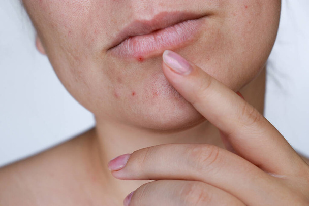 fechar a pele natural mulher acne ruim com cicatrizes. Foto de alta qualidade - Foto, Imagem