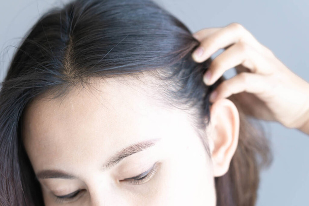 mladá žena s vážným problémem vypadávání vlasů  - Fotografie, Obrázek