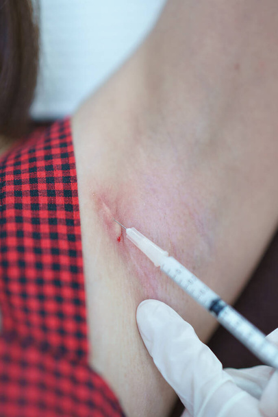 Closeup doctor injection treatment for keloids on the armpit.  - Foto, Imagem