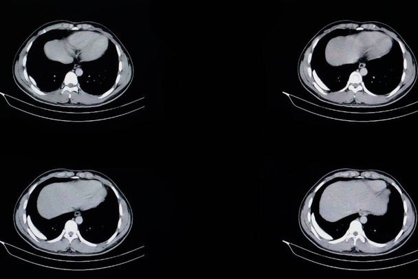 バックグラウンド上の肺の質量X線, 閉じる - 写真・画像
