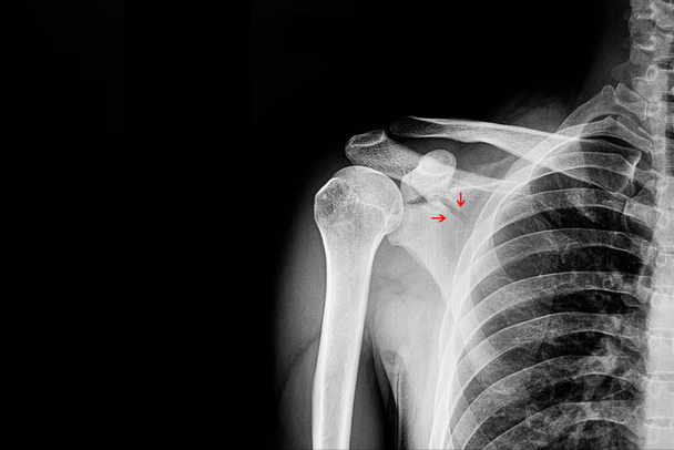Скапулярный перелом, рентген - Фото, изображение