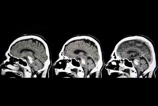 hémorragie du tronc cérébral, radiographie - Photo, image