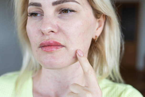 Biorevitalización real de la piel sobre un fondo blanco. Rastros de inyecciones de biorevitalización en la cara de una mujer. Rastros de agujas de biorevitalización - Foto, imagen
