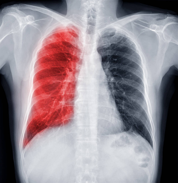 "Radiografia de tórax de tórax humano ou pulmão para detectar tuberculose" - Foto, Imagem