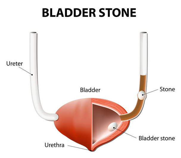 Piedras en la vejiga urinaria y el uréter
 - Vector, imagen