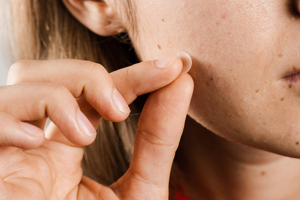 Chica con acné palo alrededor de parche de acné en su mejilla. Mujer que usa parches de acné para el tratamiento de la espinilla y la rosácea de cerca. Cosmetología de limpieza del rejuvenecimiento facial - Foto, imagen