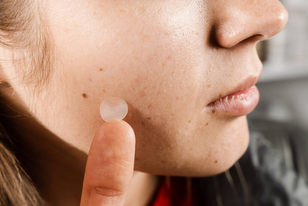 Girl with acne stick round acne patch on her cheek. Woman using acne patches for treatment of pimple and rosacea close-up. Facial rejuvenation cleansing cosmetology - Photo, Image