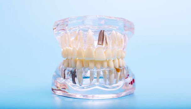 Dental jaw model over blue background. Dentist dental prosthetic teeth, gums, roots close-up. - Photo, image