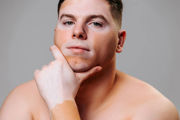 Man young vitiligo poses gray background in studio showing the beauty of the body affected disease. Self acceptance and self care is most important thing in the lives of people with skin conditions. - Foto, Bild