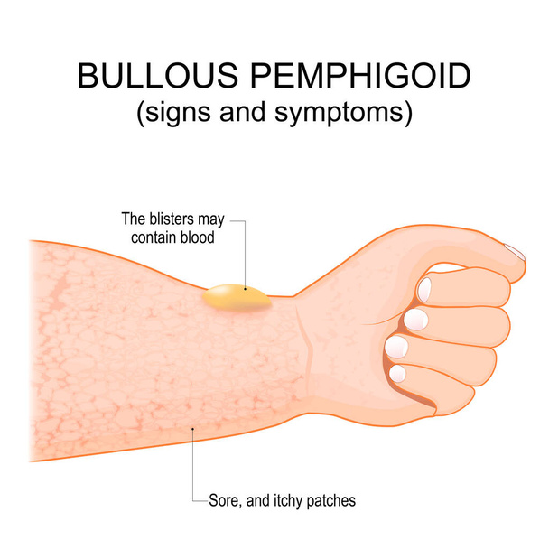 Bulliger Pemphigoid. autoimmune juckende Hauterkrankung. Hautzustand älterer Menschen. Es beginnt mit einem juckenden Hautausschlag, dann können sich Blasen auf der Haut bilden. Vektorplakat - Vektor, Bild