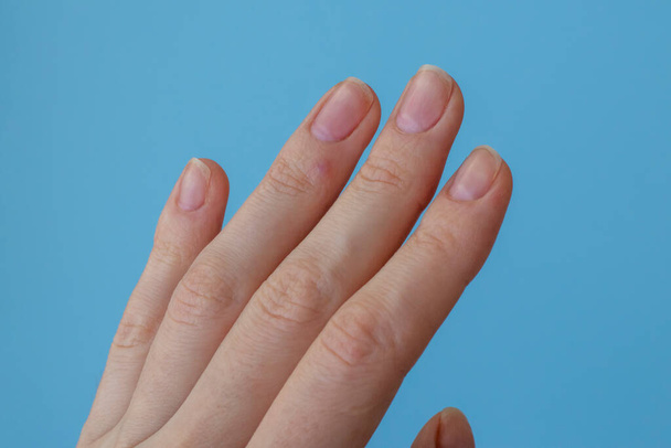 Eine Warze auf der Hand einer Frau am Ringfinger im Heilungsprozess nach flüssigem Stickstoff und Lasertherapie. Verruca - Foto, Bild