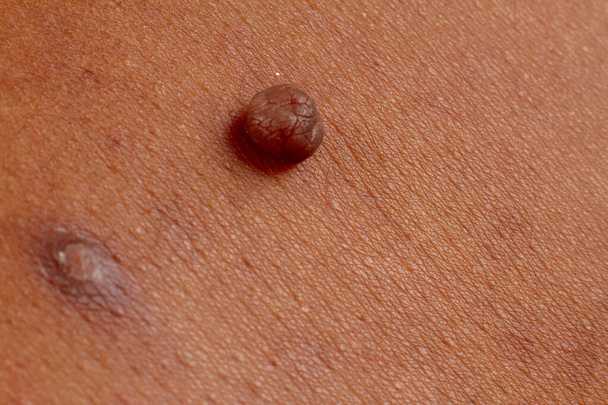 menselijke huidtextuur. wratten en puistjes op de huid micro foto. close-up foto. - Foto, afbeelding