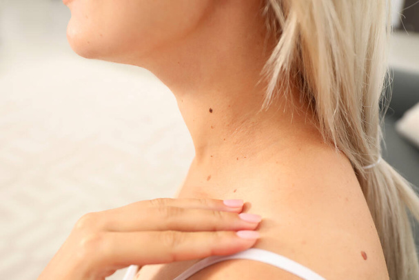 Closeup view of woman`s body with birthmarks indoors - Zdjęcie, obraz