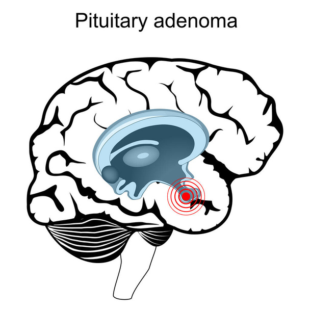 Aivolisäkkeen adenooma. Ihmisen aivojen poikkileikkaus. Lähikuva hypofysiikasta. umpirauhanen. vektorijuliste - Vektori, kuva