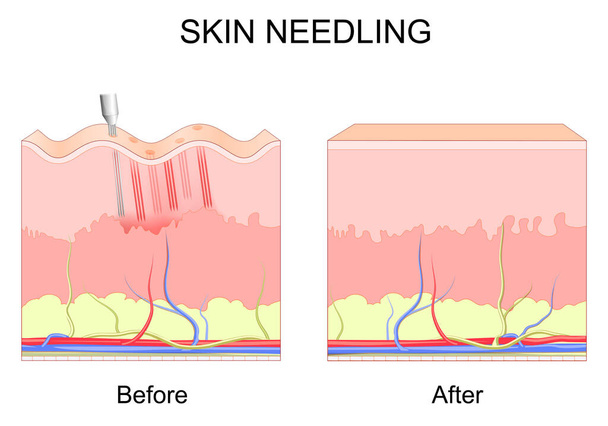 マイクロニードリング。皮膚の治療だ。化粧品の前と後の手順.しわを持つ人間の皮膚の層の断面。ダーマリングのプロセスの終了.コラーゲン誘導療法.ベクターポスター - ベクター画像