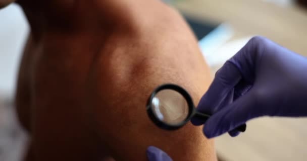 Ruce doktora v rukavicích se zvětšovacím sklem zkoumají kůži muže, zblízka. Návštěva dermatologa - Záběry, video