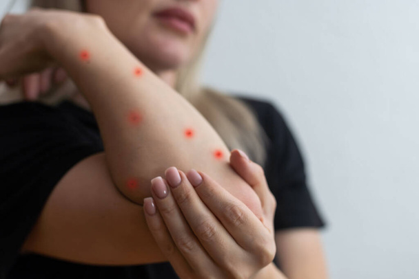 Kranke allergische Hautausschlag Dermatitis Ekzem Haut des Patienten. - Foto, Bild