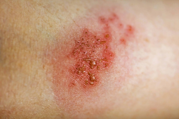 Virus dell'herpes zoster infetto dalla pelle
 - Foto, immagini