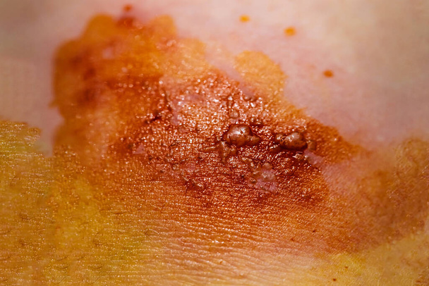 Virus du zona infecté par la peau
 - Photo, image