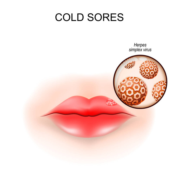 Lippenherpes. Fieberblasen. Nahaufnahme eines Herpes Simplex Virus. Vektorillustration - Vektor, Bild