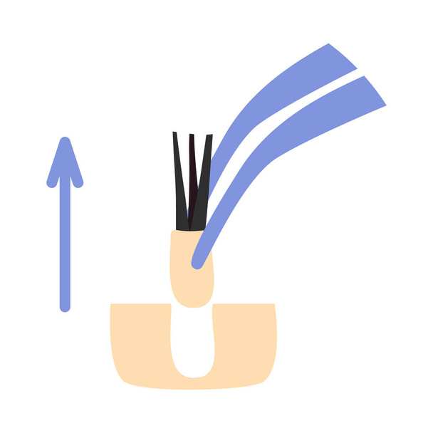 Hair transplant treatment forceps symbol. Surgical tweezers pulling out hair follicle. Alopecia medical procedure equipment tool. Hair loss diagnosis and transplantation concept. Vector illustration. - Vector, afbeelding