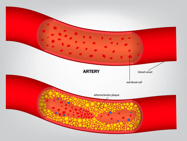 realistisch type cholesterol in geïsoleerde slagader. eps vector - Vector, afbeelding