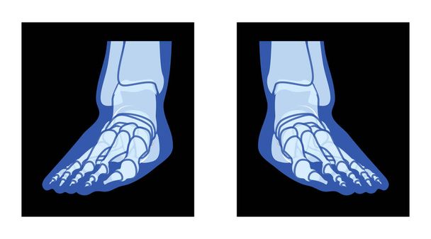 X-Ray Foot Legs Skeleton Human body Bones - malleolus, Phalanges adult people roentgen front view. Realistic flat blue color concept Vector illustration of medical anatomy isolated on black background - Vector, Image