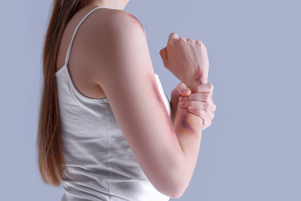 Young woman with bruised arm on grey background, closeup - Photo, Image