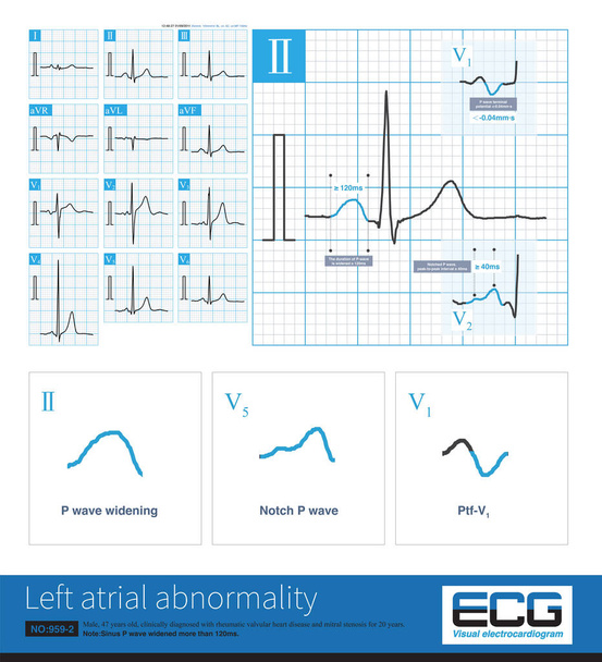 Na clínica, a estenose mitral é uma doença cardíaca orgânica comum que leva à anormalidade do átrio esquerdo no ECG. A duração da onda P sinusal aumenta em mais de 120ms. - Foto, Imagem