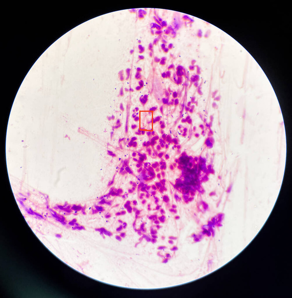 Gram-negative diplococci in vaginal smear.Gonorrhea is a sexually transmitted disease caused by infection with the Neisseria gonorrhoeae bacterium - Photo, Image
