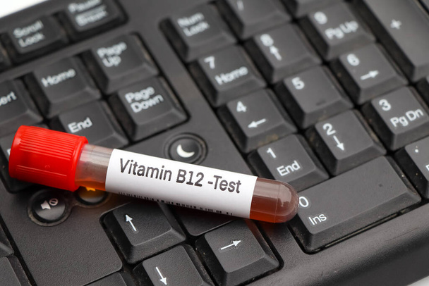 Échantillons de sang pour l'analyse de vitamine B12 en laboratoire, échantillon de sang dans une éprouvette - Photo, image