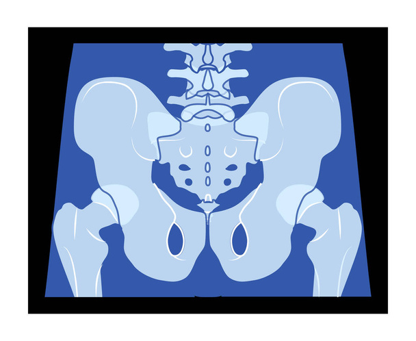 X-Ray pelvis Skeleton Hip Human body Bones adult people roentgen back view. 3D realistic flat blue color concept Vector illustration of medical anatomy isolated on black background - Vector, Image