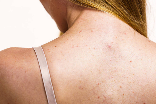 Health problem, skin diseases. Young woman showing her back with acne, red spots. Teen girl with many pimples. - Fotoğraf, Görsel