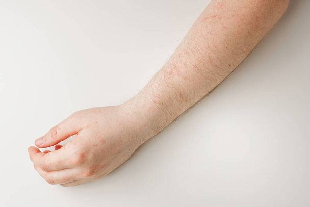 Мужская рука на белом столе с красными пятнами на коже. Аллергическая реакция, проблемы с кожей, дерматология. Не та диета, побочный эффект от приема лекарств - Фото, изображение