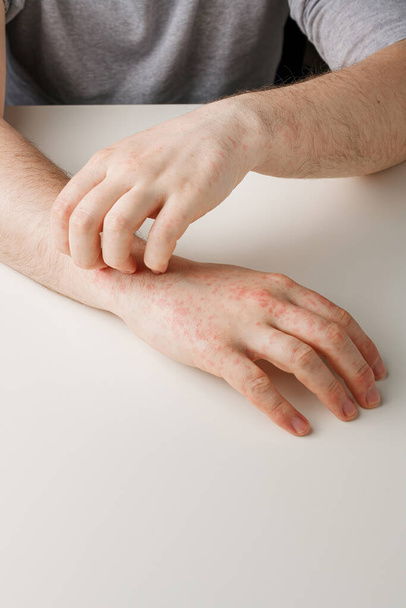 Manos masculinas arañando manchas rojas con picor en la piel. Reacción alérgica por dieta incorrecta, por efecto de tomar antibióticos o medicamentos. Enfermedad cutánea - Foto, imagen