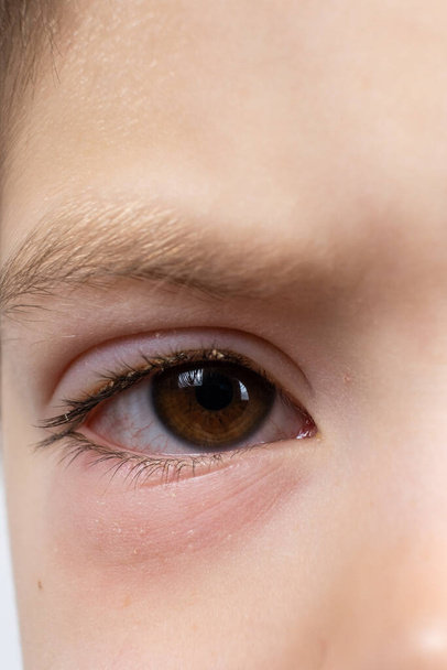 Konjonktivit, konjonktivit iltihabı olan 5 yaşındaki bir çocuğun gözü. Yakın plan. Pediatrik göz doktoru - Fotoğraf, Görsel