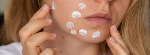 顔ににきびのためのクリーム血清療法、認知できない女性は化粧を適用します。女性のクローズアップにきびは、化粧品にアレルギーが発疹肌、傷やスポットに直面しています。バナーの問題スキンケアと健康 - 写真・画像